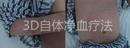 住院45天,治好一身红皮