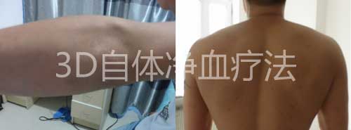住院45天,治好一身红皮