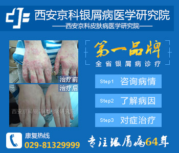 郑州有没有牛皮癣医院 郑州有没有牛皮癣医院