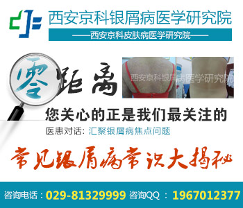 郑州权威牛皮癣医院 郑州权威牛皮癣医院